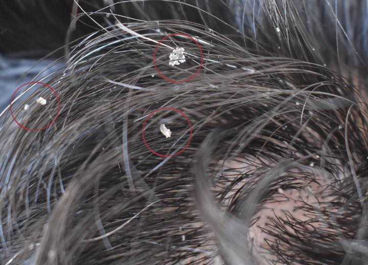 Cabelo com flocos de caspa