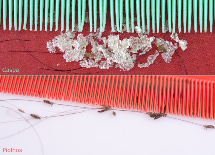 A diferen&ccedil;a entre caspa e piolhos